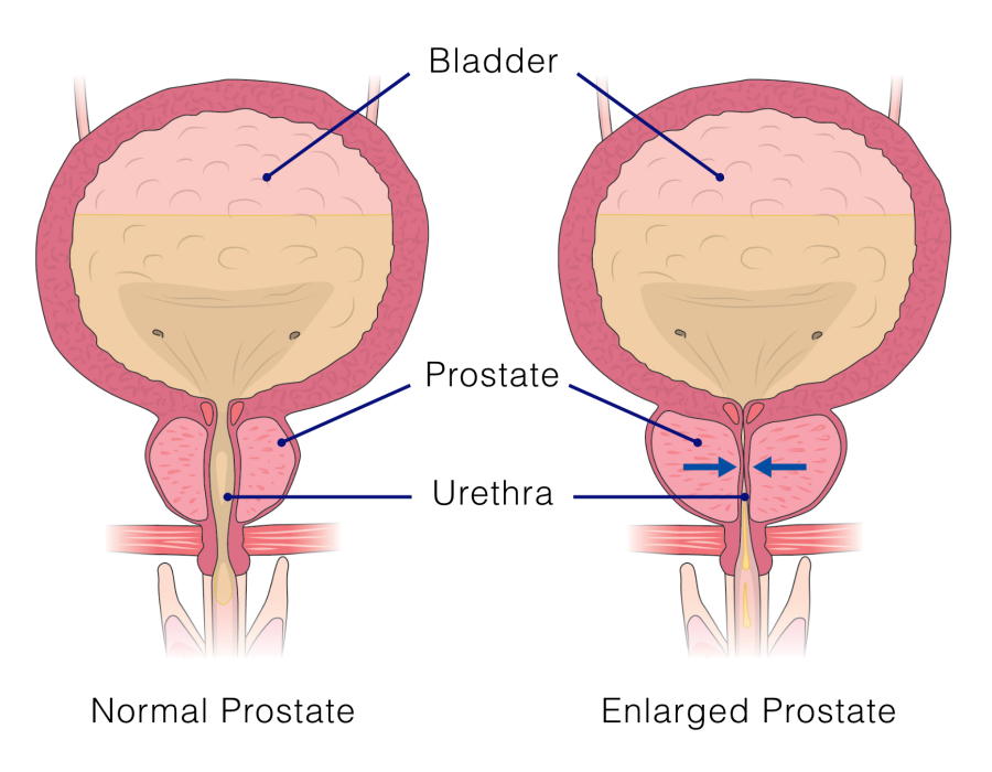 Normal Prostate vs. Enlarged Prostate
