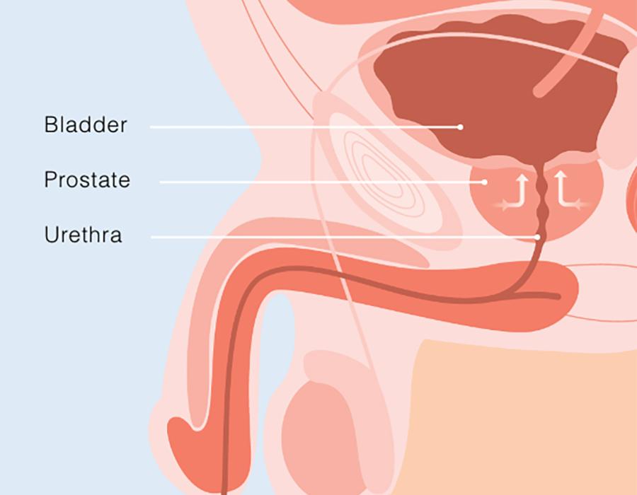 Benign Prostatic Hyperplasia Diagram
